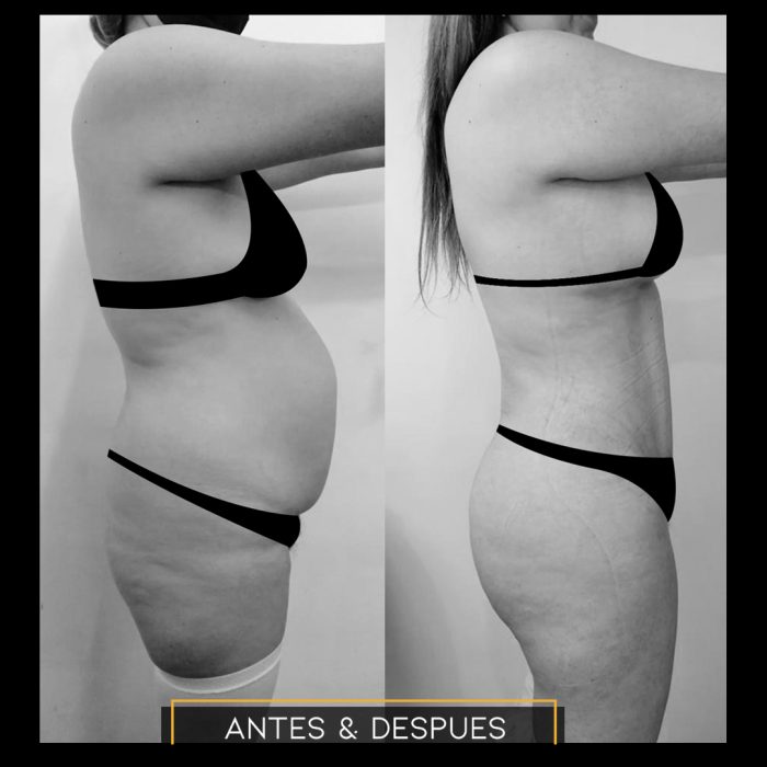 Antes y despues de Beauty Safe Clinic